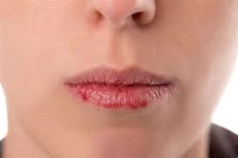 dudak çatlamasının sebebi nedir